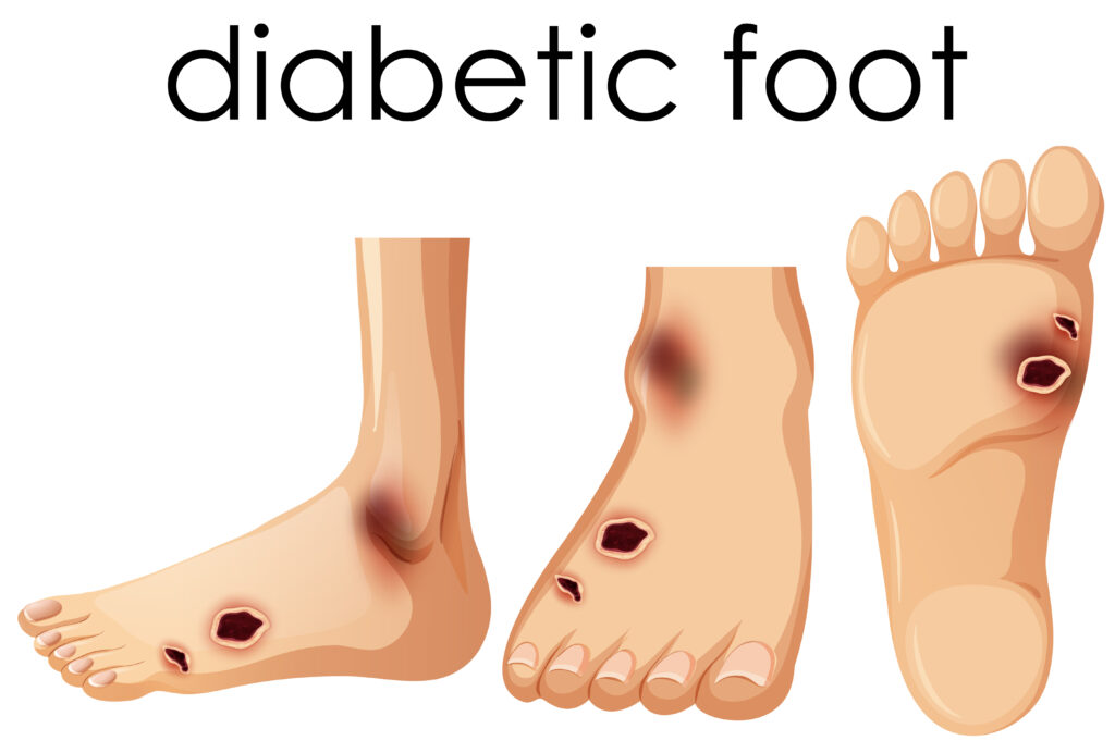 Diabetic Foot Treatment in Hyderabad