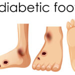 Diabetic Foot Treatment in Hyderabad