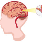 Aneurysm Treatment in Hyderabad