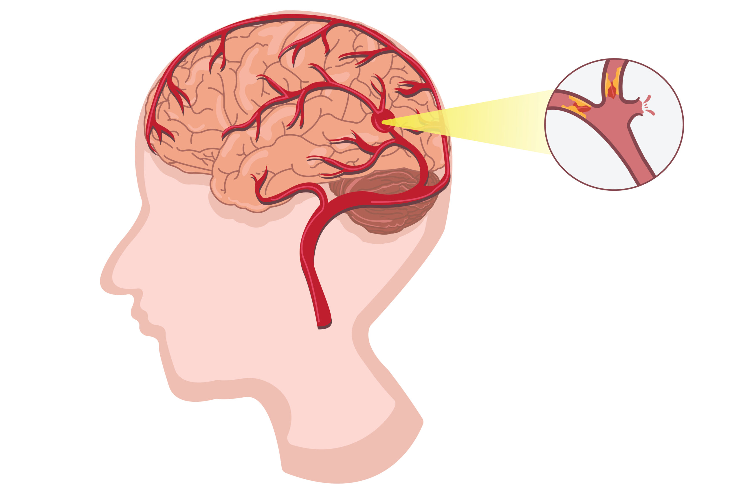 Aneurysm Treatment in Hyderabad: Expert Care for Your Vascular Health