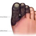 Gangrene Treatment in Hyderabad