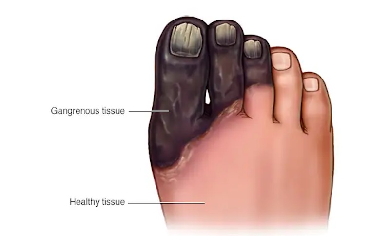 Gangrene Treatment in Hyderabad: Expert Care to Save Limbs and Lives