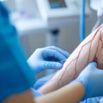 Vascular probelm