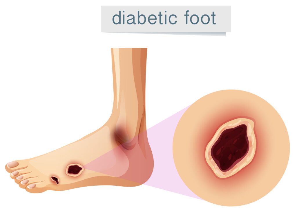 early stage diabetic foot ulcer