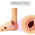 early stage diabetic foot ulcer