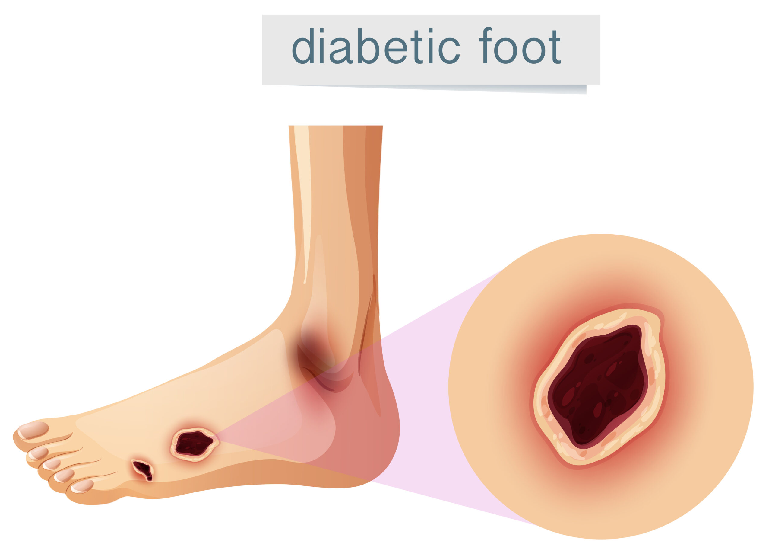 Early Stage Diabetic Foot Ulcer – Catch It Before It Gets Serious