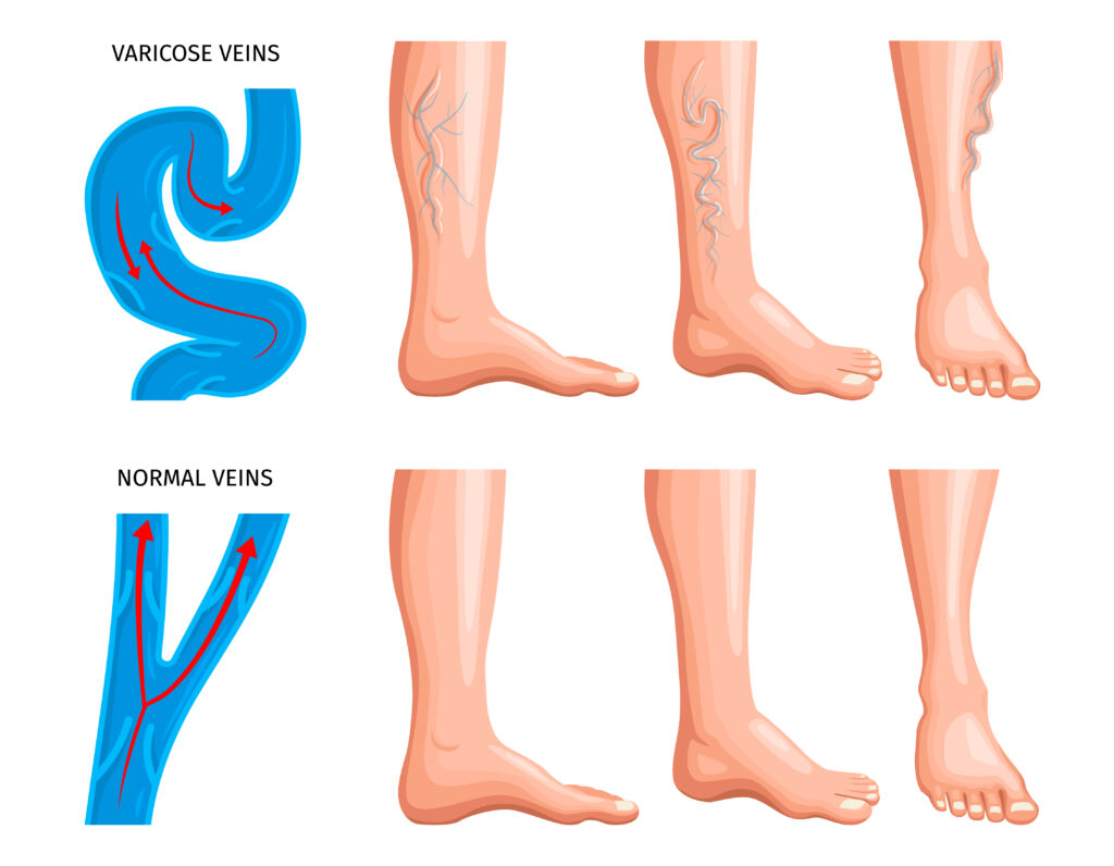 Varicose Veins Treatment Cost