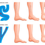 Varicose Veins Treatment Cost