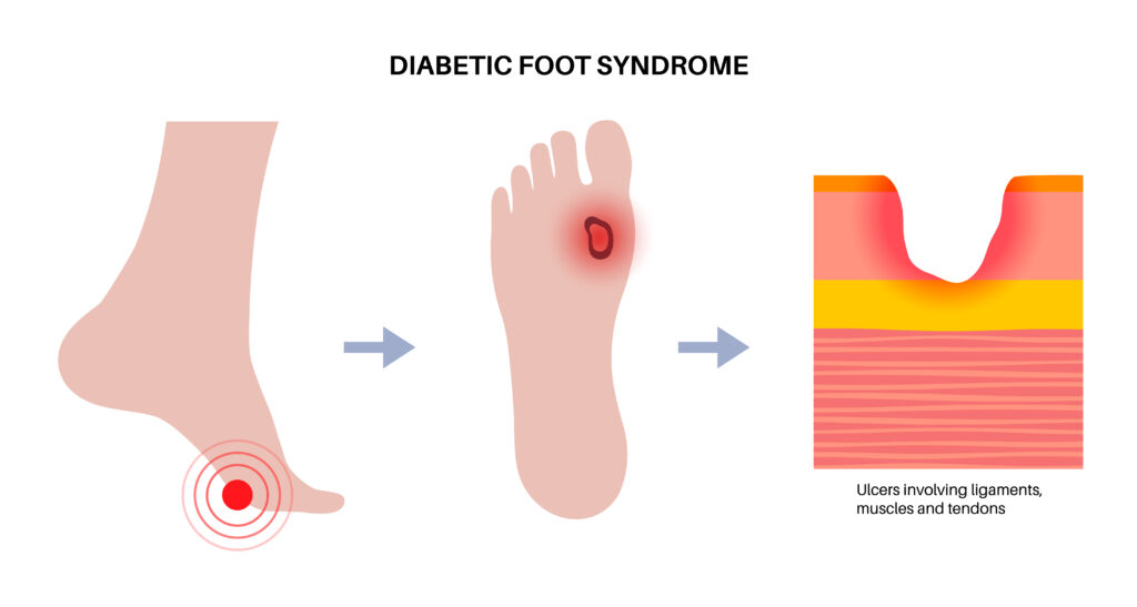 diabetic foot ulcer
