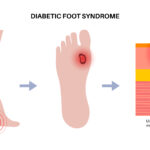 how to identify a diabetic foot ulcer before it becomes serious