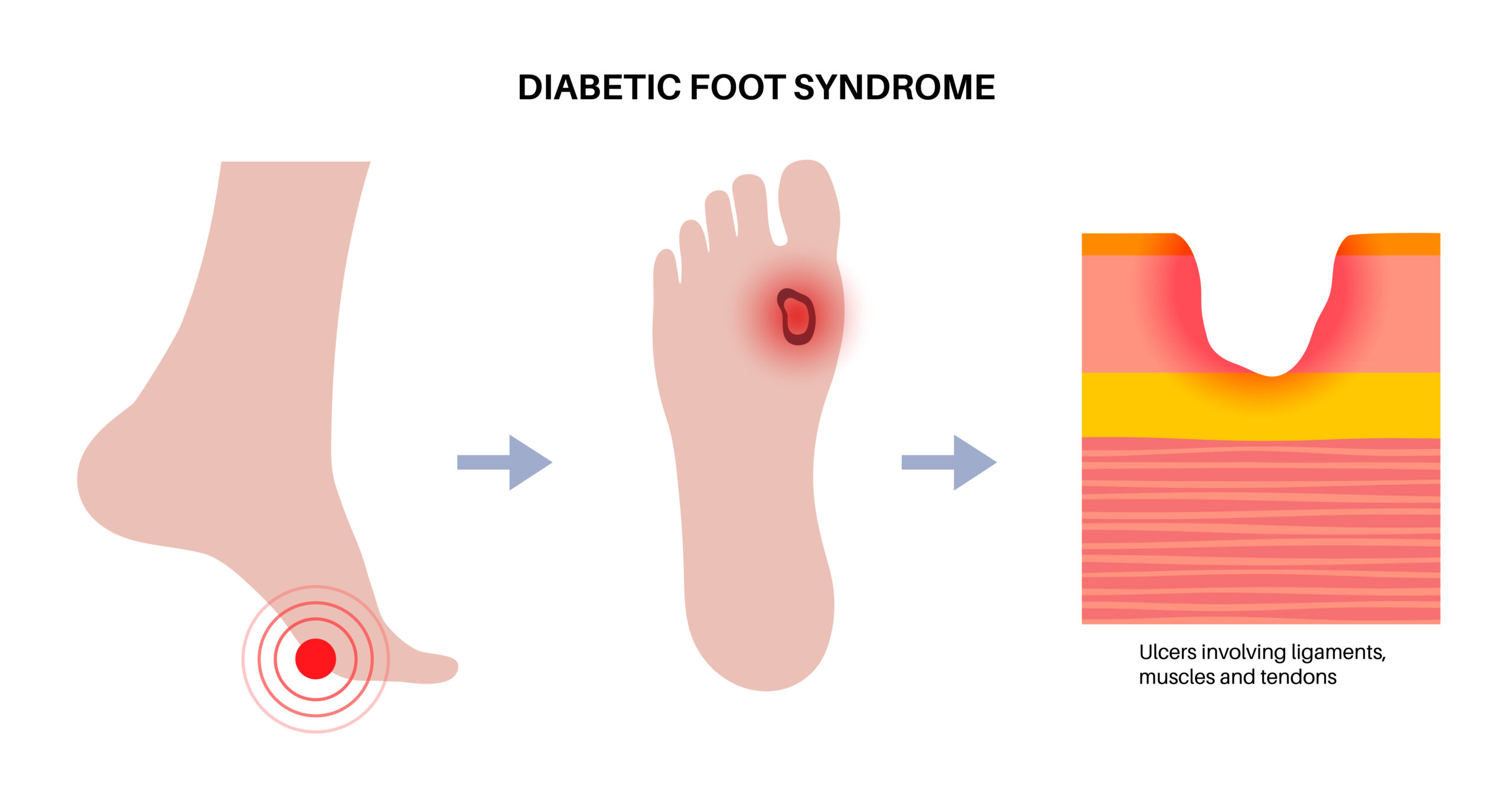 how to identify a diabetic foot ulcer before it becomes serious 