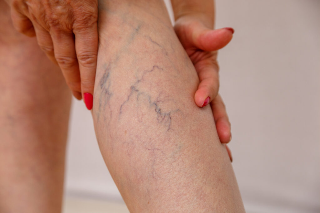 Varicose Veins Laser Treatment Cost