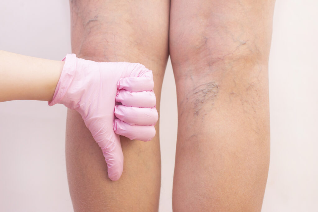 Varicose Veins in the Legs: