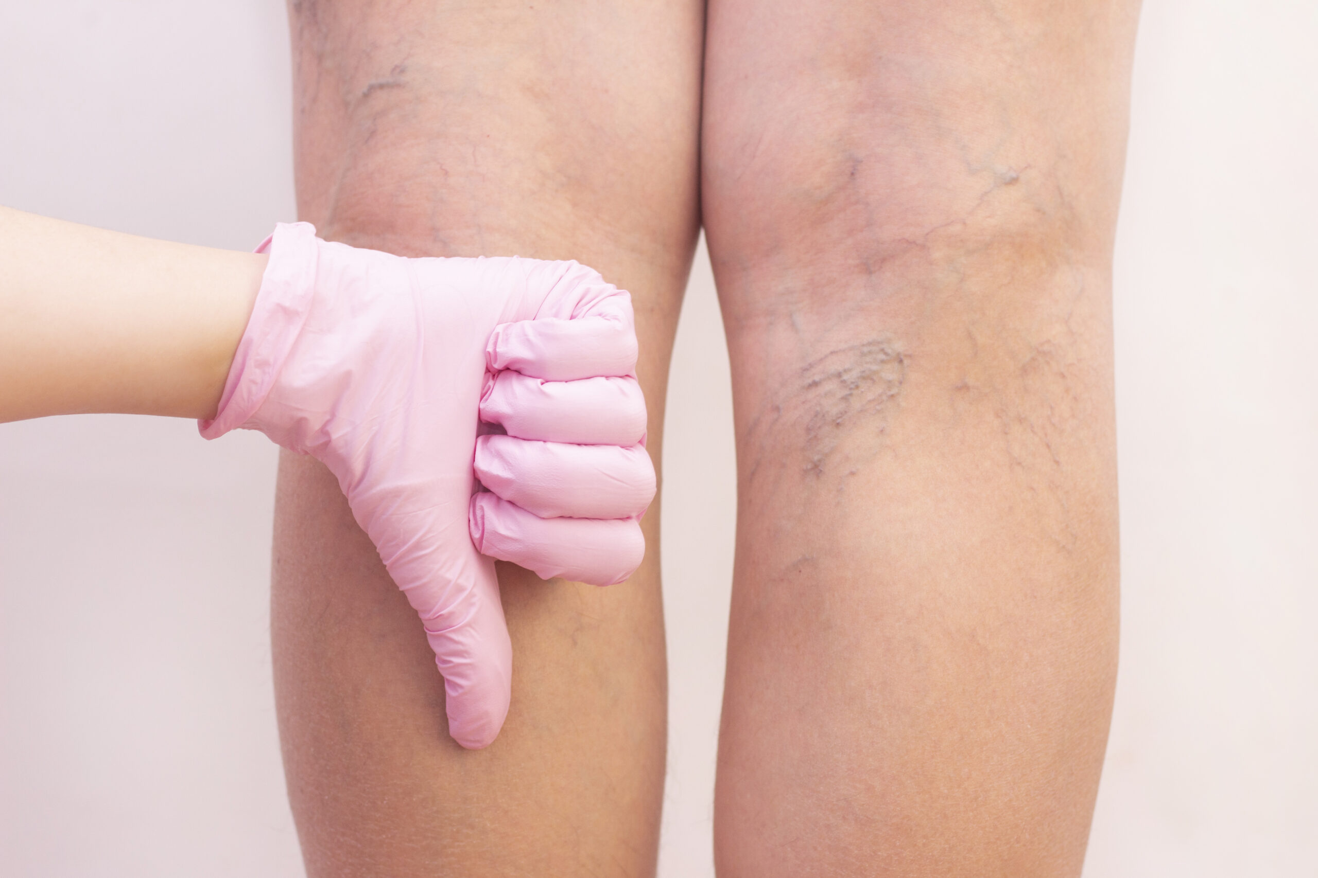 🦵 Treatment for Varicose Veins in Legs – Get Fast, Painless Relief in Hyderabad
