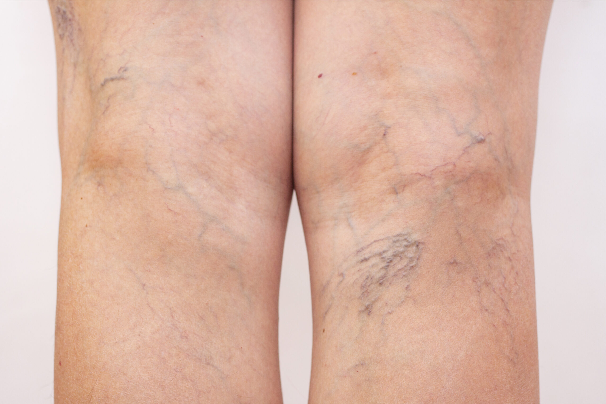 Varicose Vein Treatment Near Me – Walk Without Pain Again