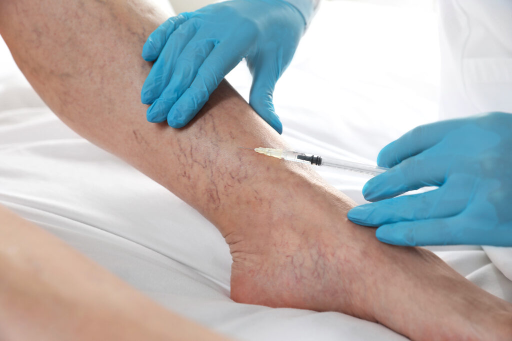 Surgical Treatment for Varicose Veins