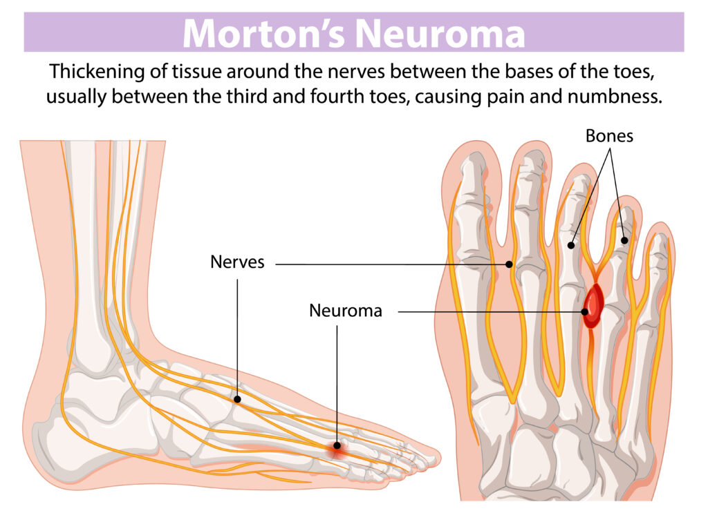 peripheral neuropathy