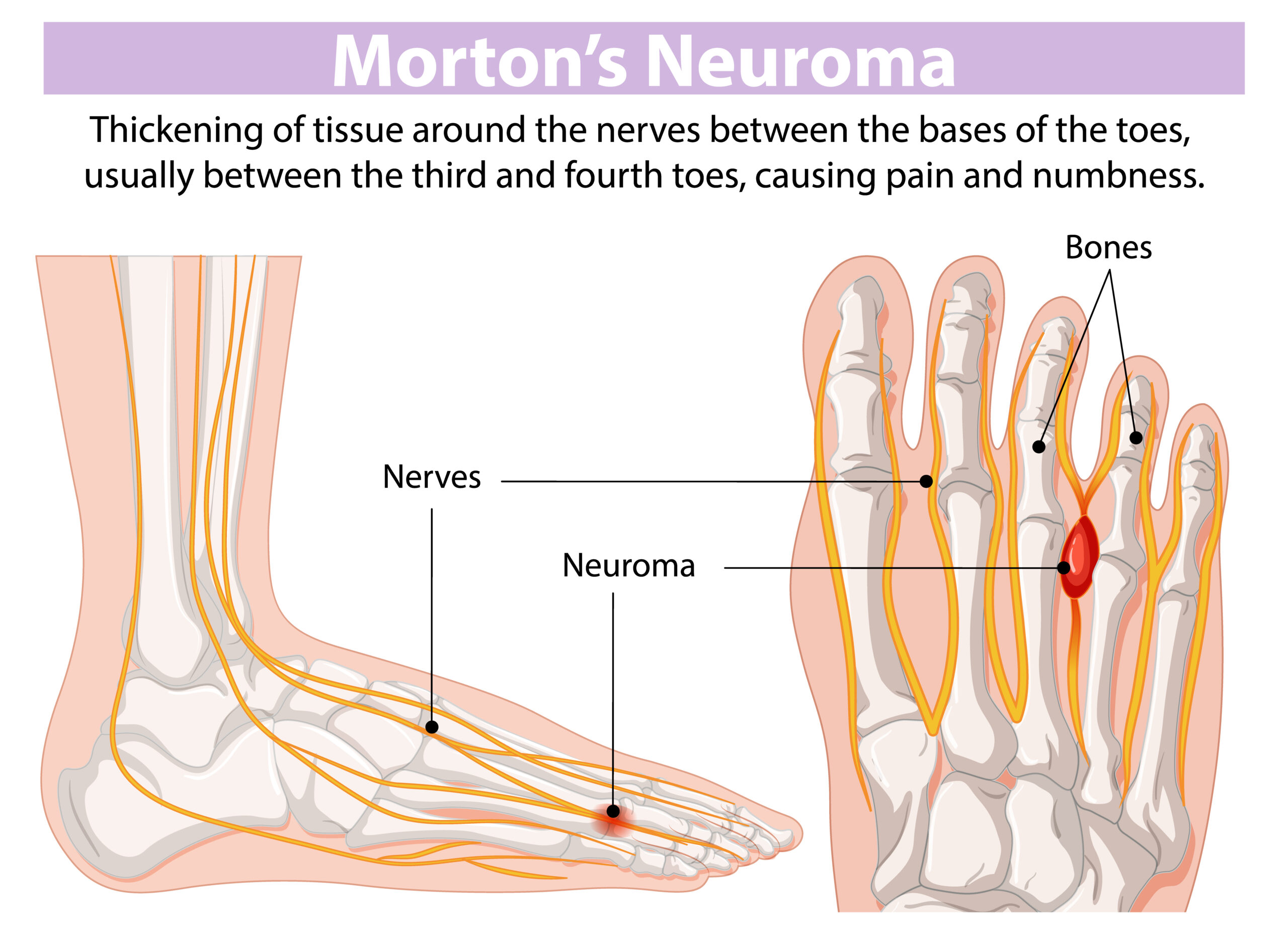 Peripheral Neuropathy: Causes, Symptoms, and Treatment Options