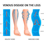 Varicose Vein Ulcer Treatment