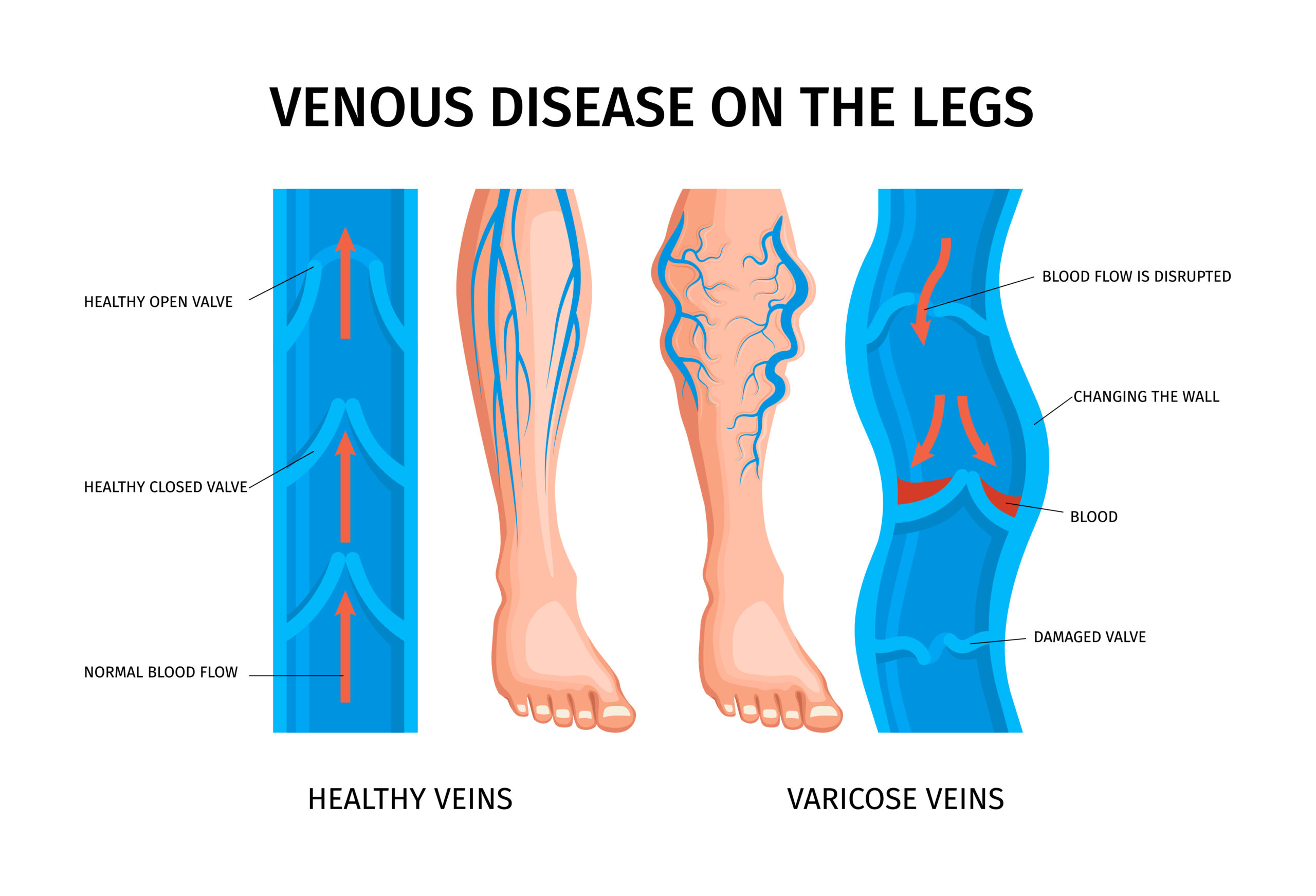Varicose Vein Ulcer Treatment