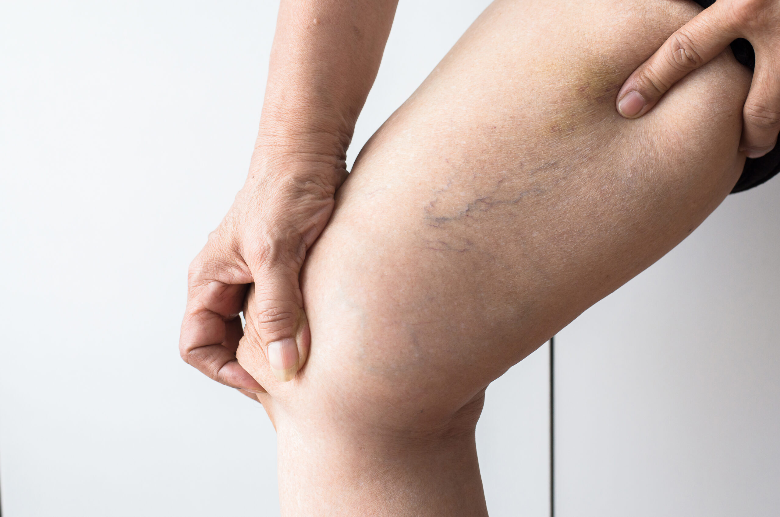 Medicines for Varicose Veins Treatment – Complete Guide
