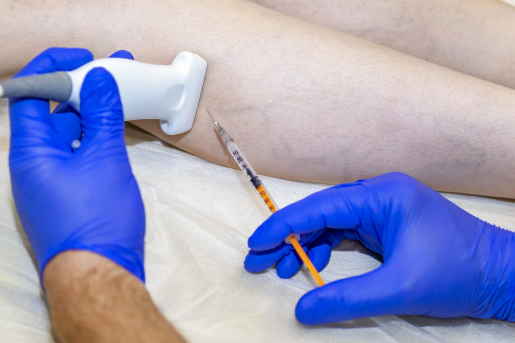 Best Treatment for Varicose Veins