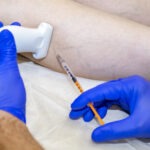 Best Treatment for Varicose Veins