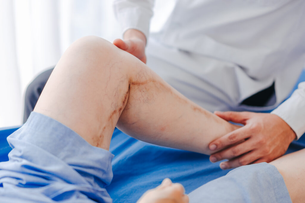 Latest Treatment for Varicose Veins