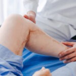 Latest Treatment for Varicose Veins