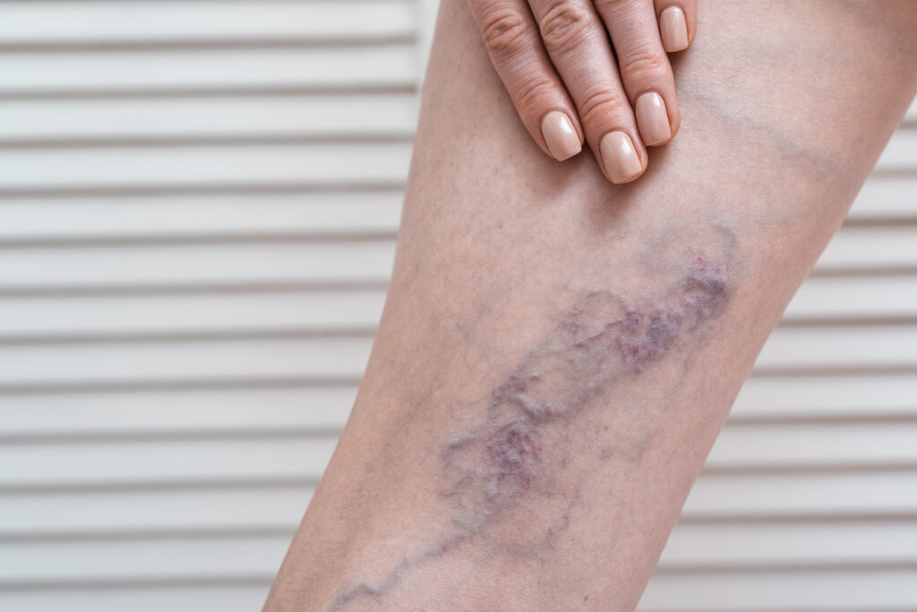varicose veins medical treatment