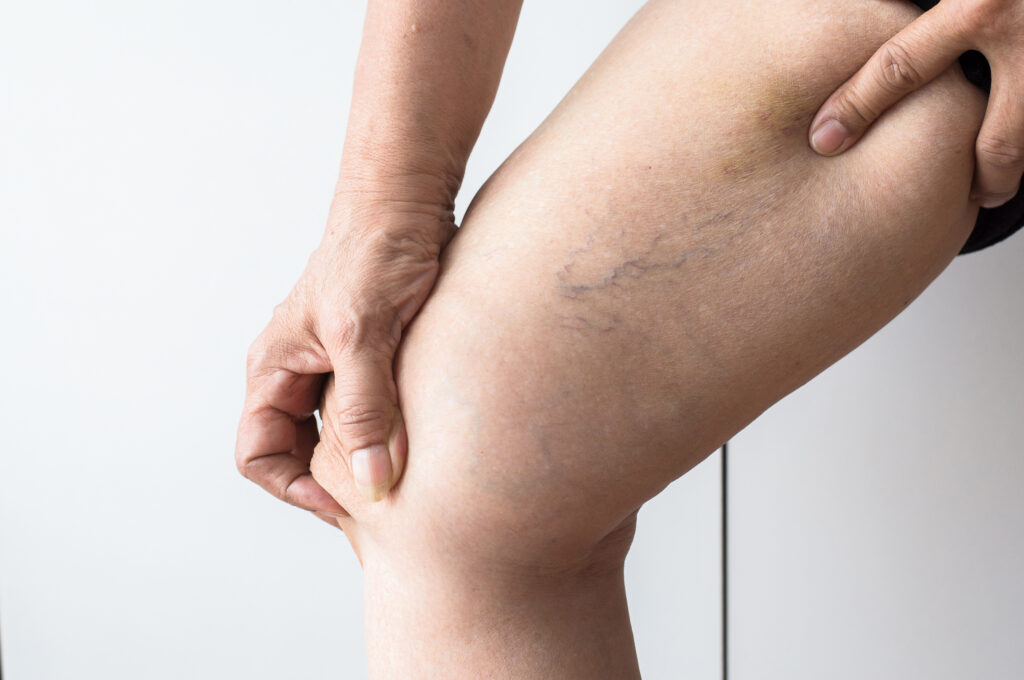 Varicose vein home Treatment