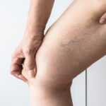 Varicose vein home Treatment