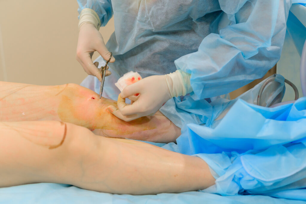 Endovenous Laser Treatment (EVLT) for Varicose Veins