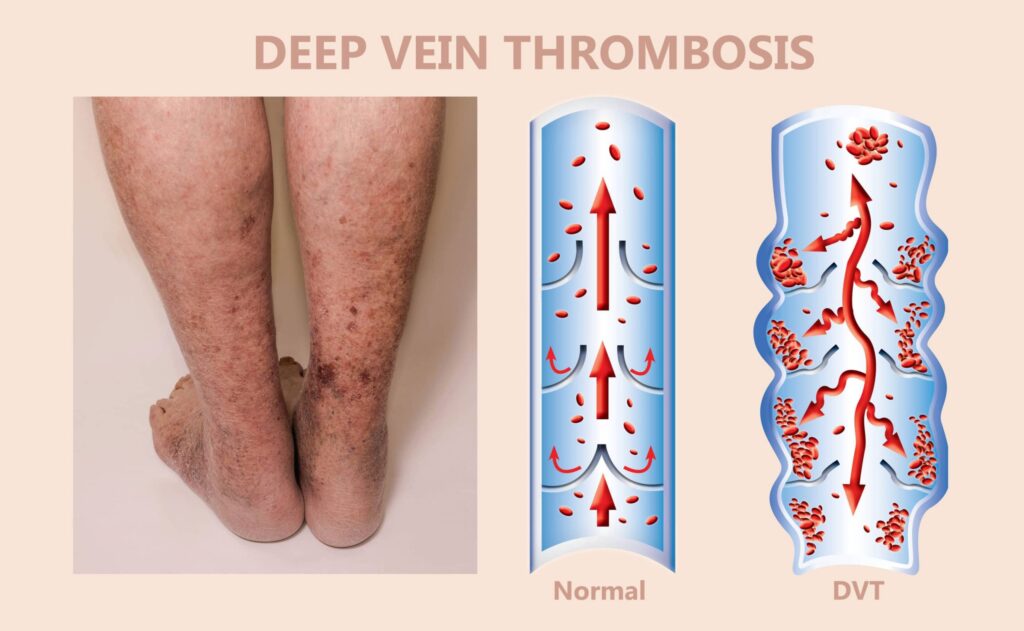 DVT Specialist Doctor Near Me