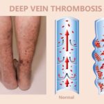 DVT Specialist Doctor Near Me