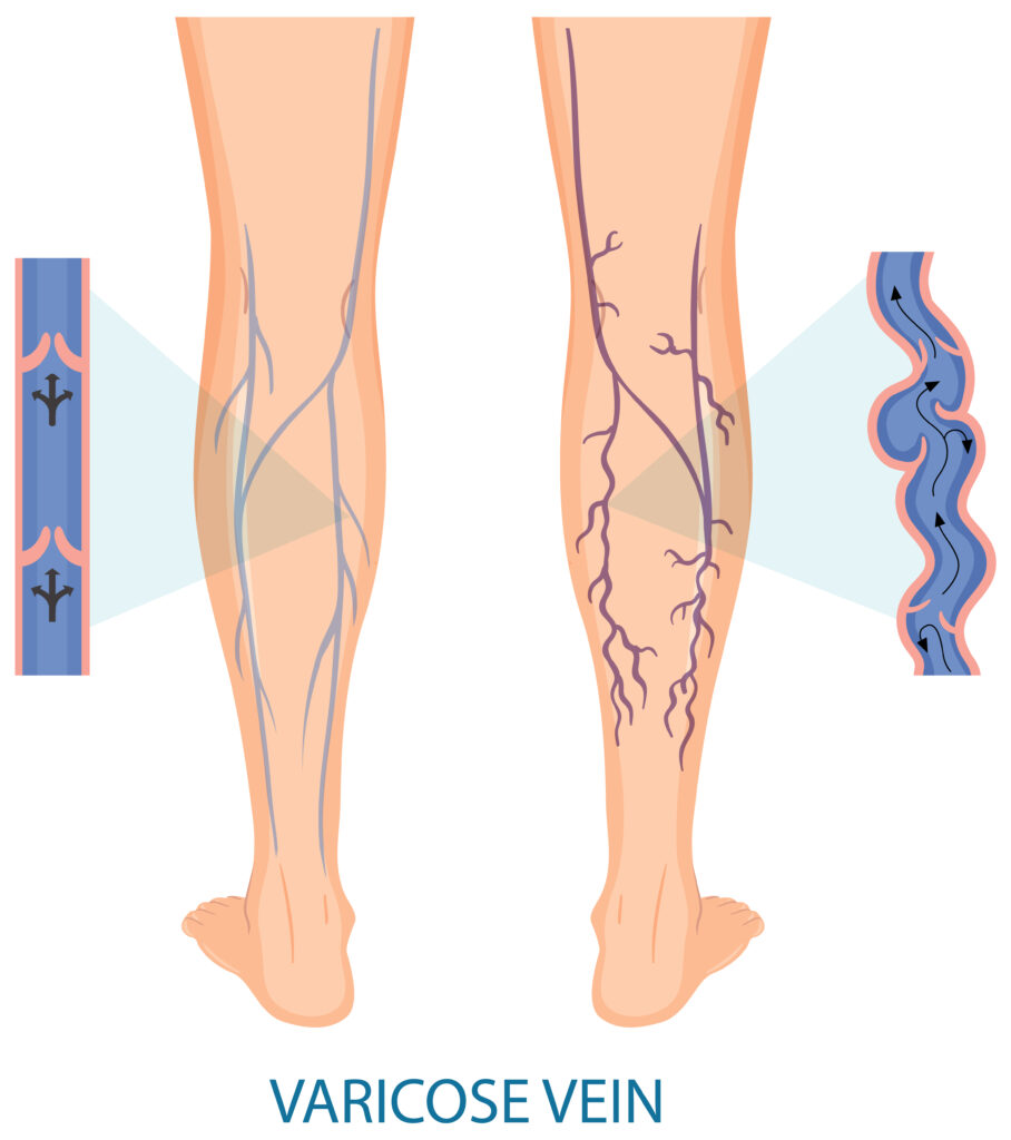 DVT Treatment Near Me