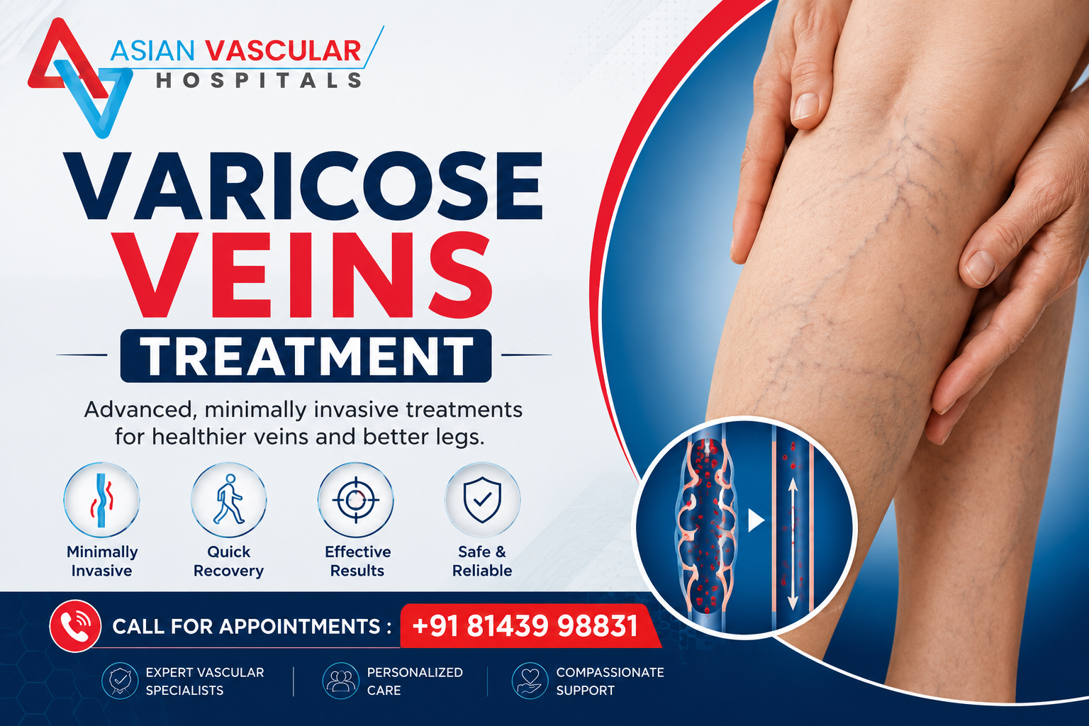 Varicose Veins Treatment Cost in Hyderabad