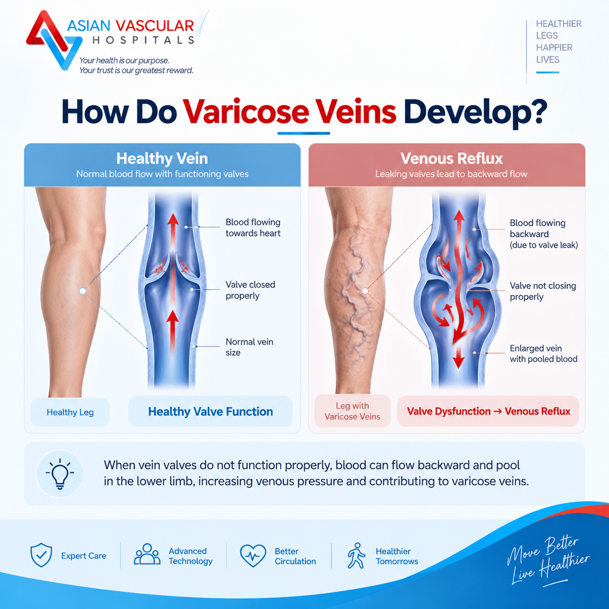 Medical diagram comparing healthy vein valves with leaking valves that cause varicose veins and venous reflux.