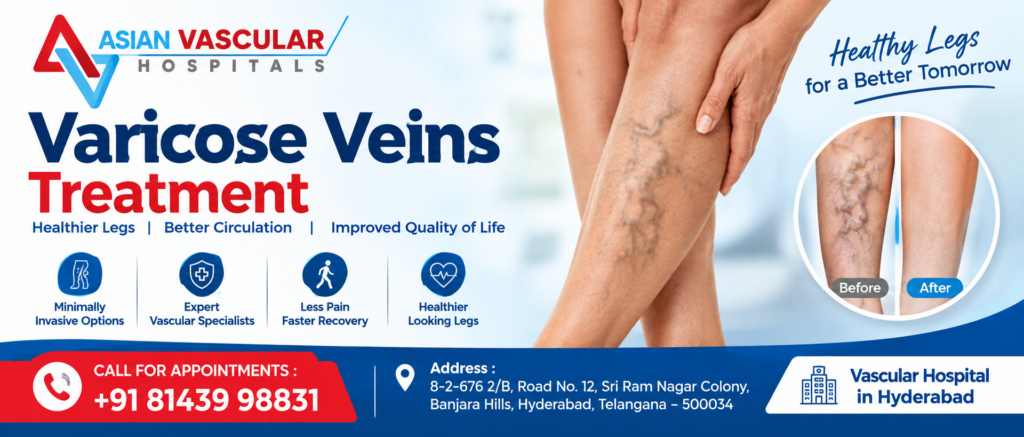 varicose veins treatment