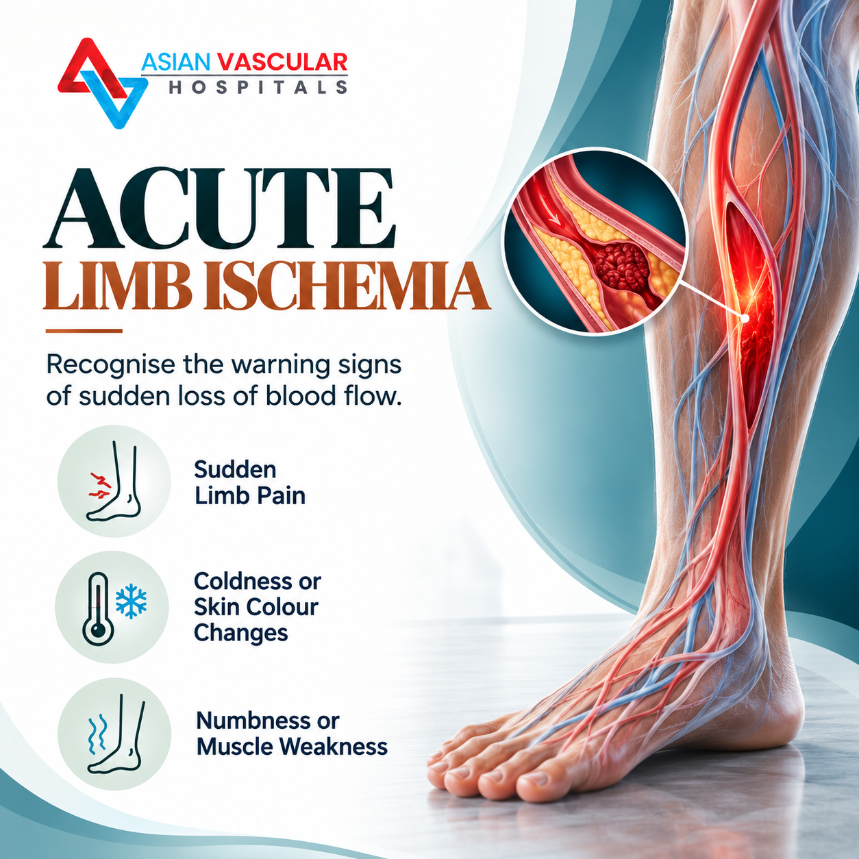 Medical illustration of an arterial blockage causing sudden loss of blood flow to the leg, associated with acute limb ischemia.