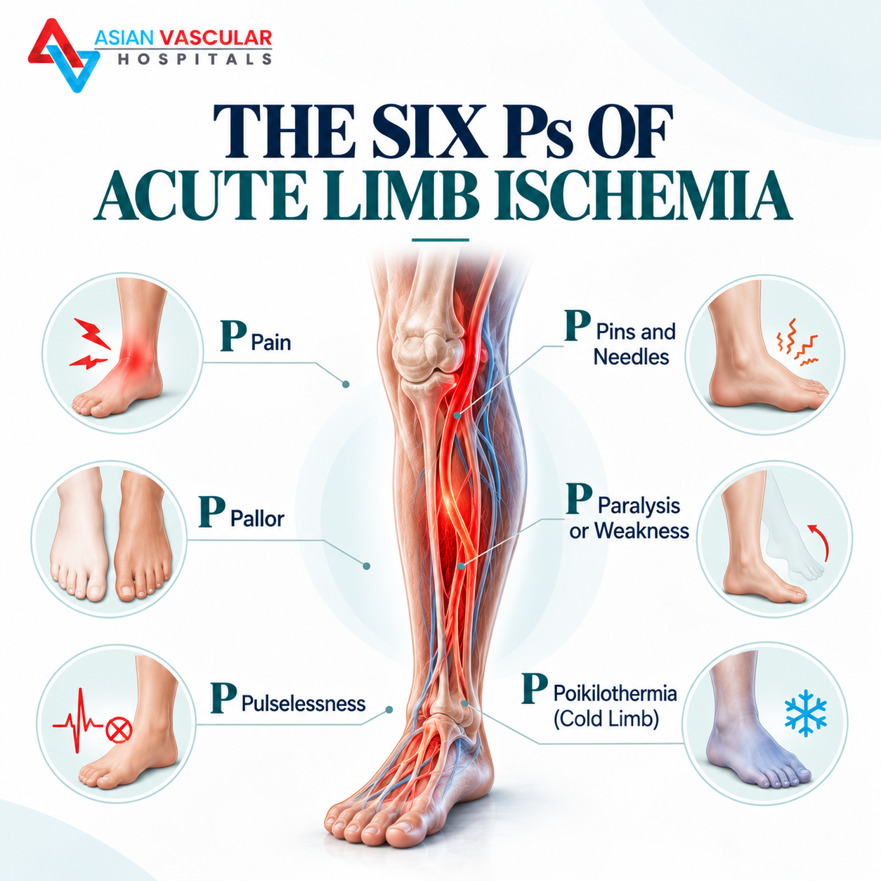 Medical infographic showing the six Ps of acute limb ischemia: pain, pallor, pulselessness, paraesthesia, paralysis and poikilothermia.